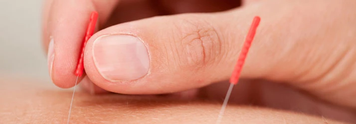 A close-up of a hand inserting thin acupuncture needles into a patient’s skin.